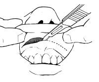 gingivolabial sulcus