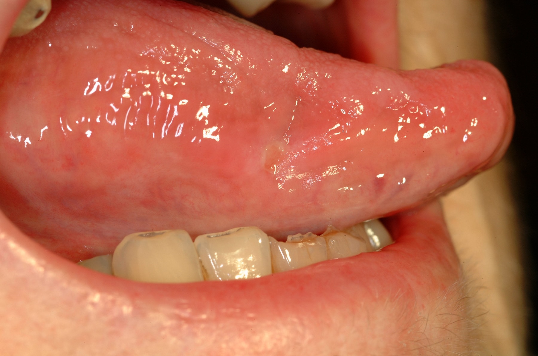 Herpetiform Ulcers