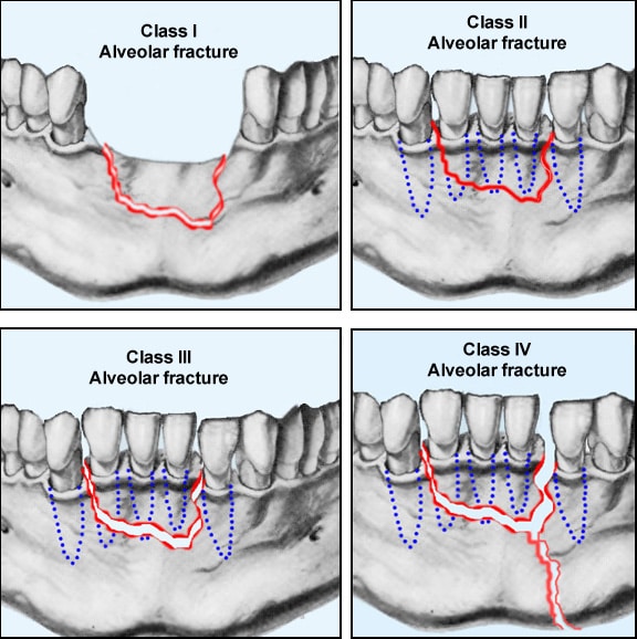 The various classes of alveolar  fractures (per Cl...