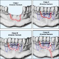 The various classes of alveolar fractures (per Cl...