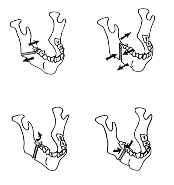 Favorable and unfavorable  fractures. Top: Horizon...