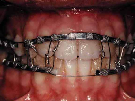 Maxillomandibular fixation using  arch bars retain...