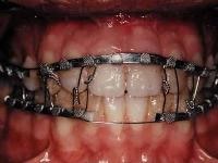 Maxillomandibular fixation using arch bars retain...