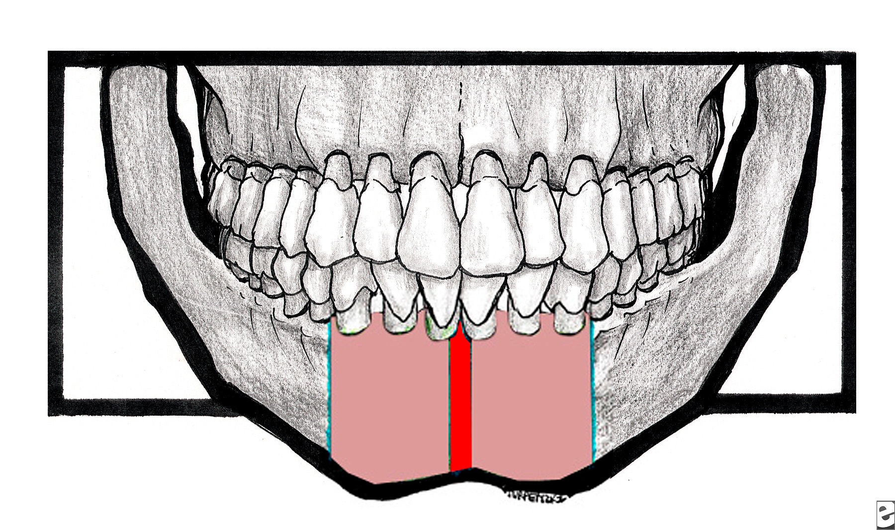 The broad red line indicates the  symphyseal area....
