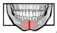 The broad red line indicates the symphyseal area....