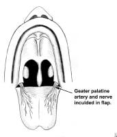 Choanal Atresia