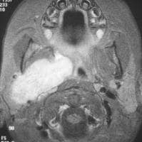 Pathology - Rhabdomyosarcoma