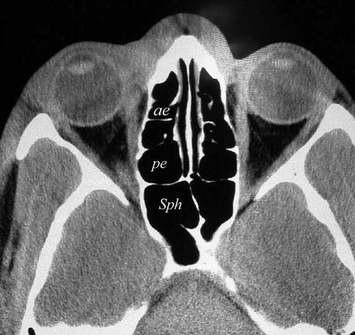 Ethmoid Air Cells 