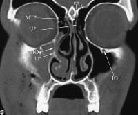 Ct Scan Of The Paranasal Sinuses History Basic Concepts Anatomy