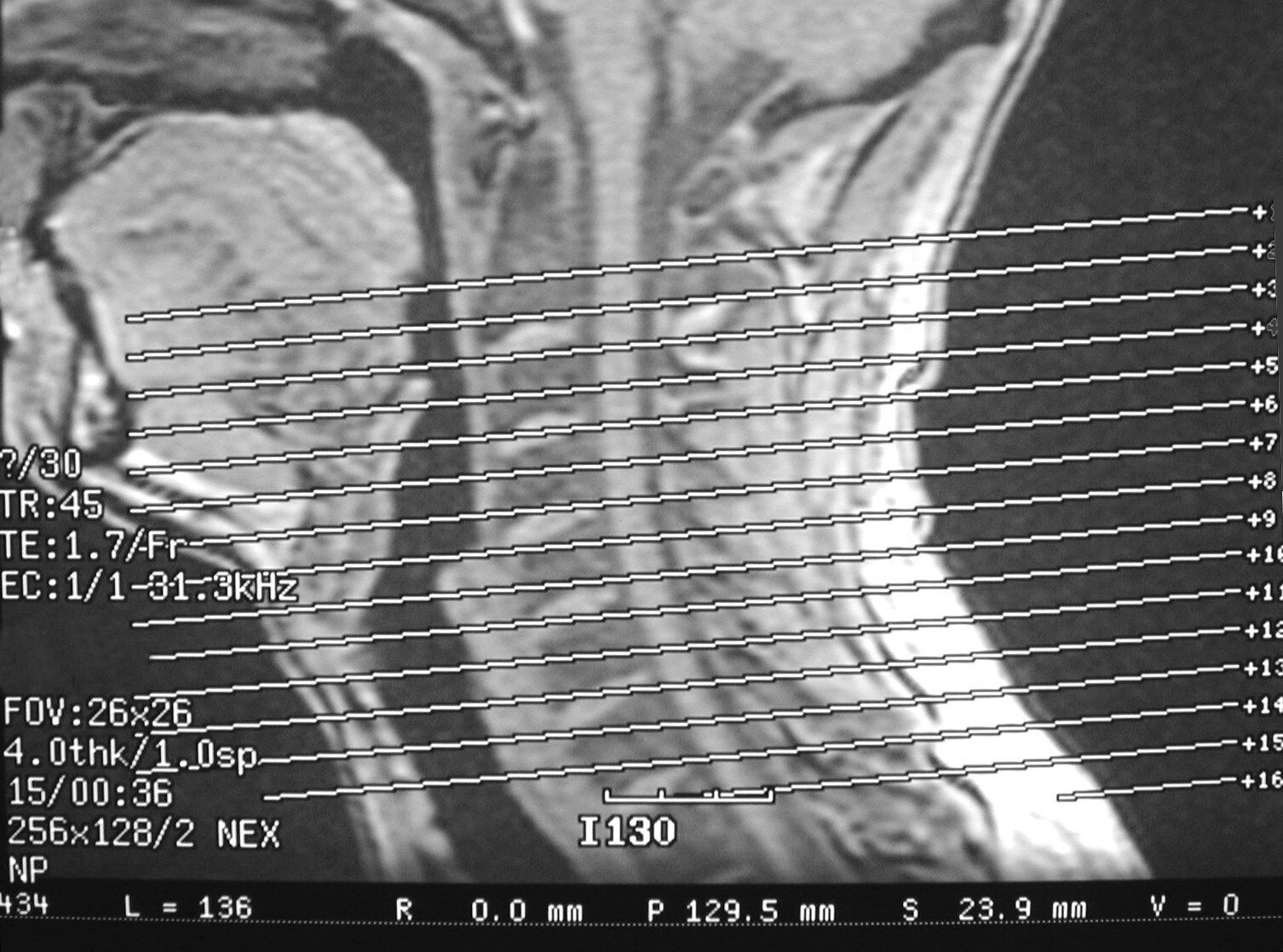 Vallecula Epiglottis