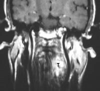 Mri Larynx