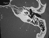 CT Scan of the Temporal Bone