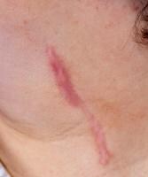 Hypertrophic Scars Face