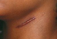 Hypertrophic scarring and keloids. Hypertrophic sc