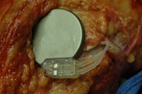 An implanted nerve stimulator. Note that the loc...