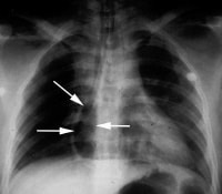 Postmortem chest radiograph showing a radiolucent...
