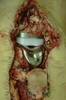 A knee replacement prosthesis in situ at autopsy,...