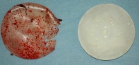 Two breast implants removed at autopsy. The one o...