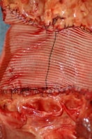 Implanted vascular graft material used to replace...