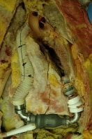 During removal of this ventricular assist device ...