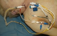 A photograph of a Swan-Ganz catheter at autopsy. ...