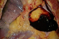 A hemopericardium as seen at autopsy.