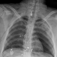 Frontal radiograph of the chest from a victim of ...