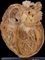 Gross heart specimen from a patient with dilated ...