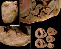 Gross findings at autopsy, ventricular arrhythmog...