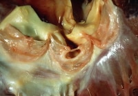 Aortic valve: healed endocarditis. Note the gapin...
