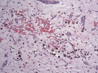 This photomicrograph demonstrates erythrocyte ext...