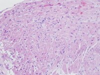Endomyocardial biopsy of a 4-year-old child with ...