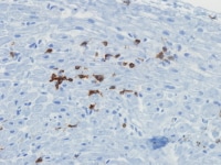 Immunohistochemical stained section of the biopsy...