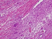 Giant cell myocarditis; intermediate magnificatio...