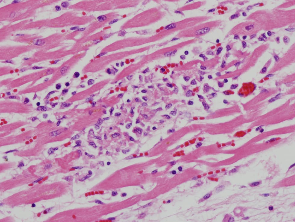 Contraction Band Necrosis. showing myocyte necrosis