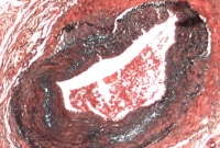 Temporal arteritis large gap in the internal elas...