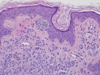 Compound Melanocytic Nevus