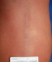 Collapsed Vein Arm