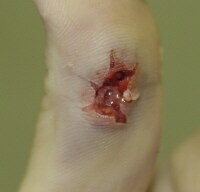 Gunshot Entry Wound