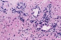 In the non-neoplastic irradiated prostate, nuclea...