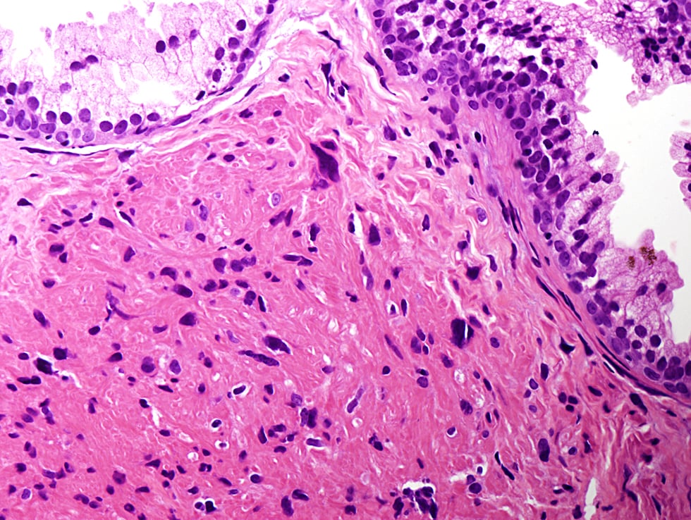  malignant potential in close association with benign prostatic glands.