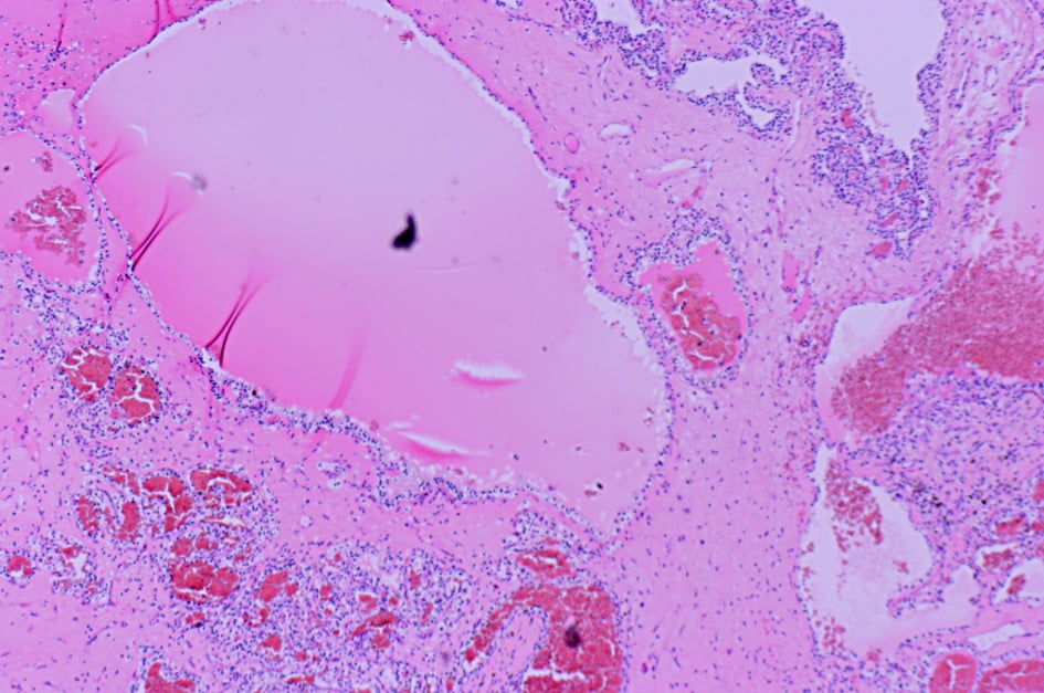 Microcystic architecture in clear cell renal cell carcinoma showing dilated 