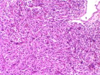 Bladder Paraganglioma Pathology Bladder Paraganglioma Pathology