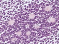 Granulosa cell tumor, microfollicular pattern. Ca...