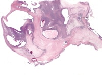 Granulosa cell tumor, macrofollicular pattern (H&...