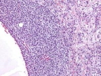 Higher magnification of tumor depicted in Media f...