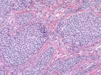Granulosa cell tumor, insular pattern (H&E, x...
