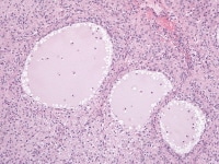Juvenile granulosa cell tumor shows round-to-oval...