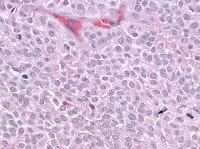 Higher magnification of the metastatic granulosa ...