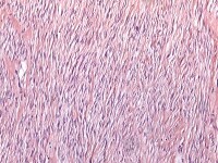 Fibroma. The cells have small, spindle-shaped nuc...